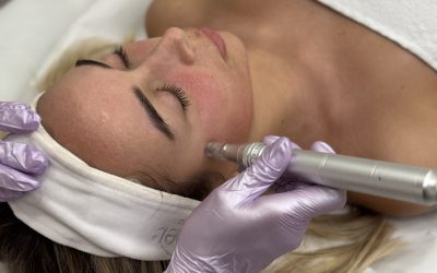 Microneedling ili Green Peel: što odabrati za ožiljke i pore?