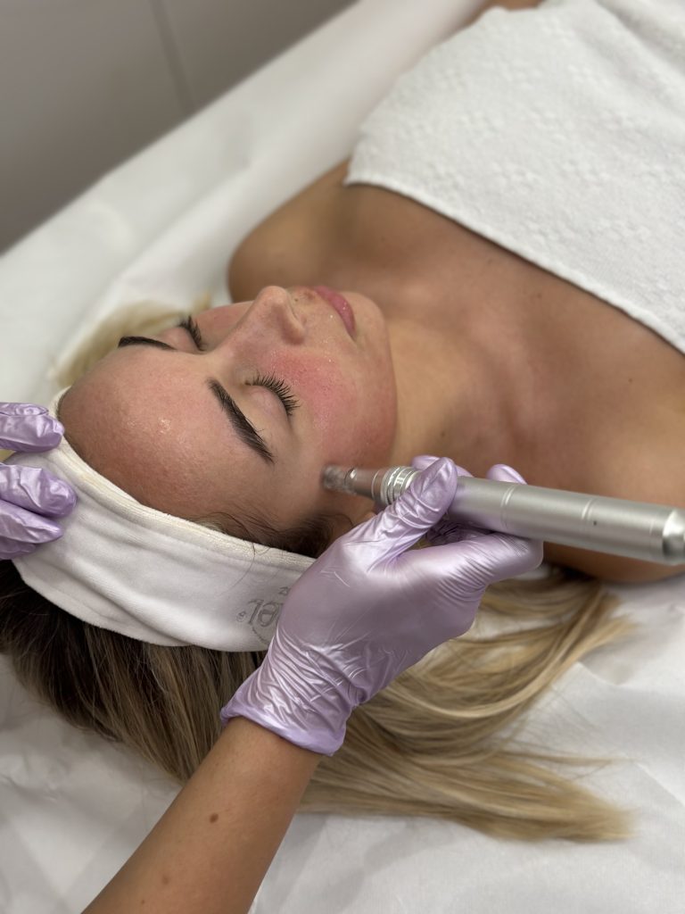 Microneedling s egzosomima