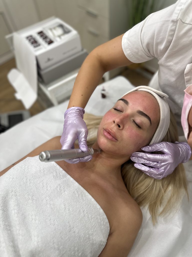 Microneedling tretman