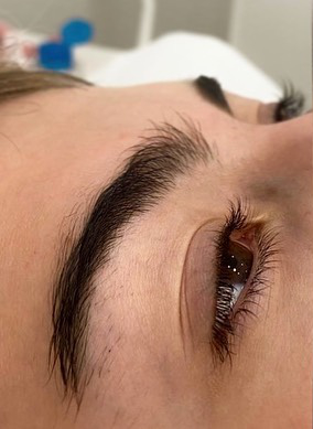 Obrve prije brow lifta